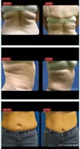 Aculaser Body Contouring