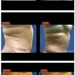 Aculaser Body Contouring