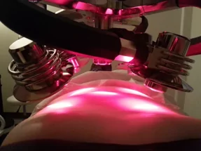 Aculaser Body Contouring