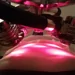 Aculaser Body Contouring