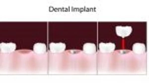 Arkansas Periodontal and Implants-Dr. Wes Shelton/ Fort Smith