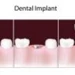 Arkansas Periodontal and Implants-Dr. Wes Shelton/ Fort Smith